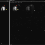 Red arrows show mismatched segmental defect at the right lung apex. Yellow arrow shows a matched segmental defect in the anterior aspect of the right lower lobe. Pink arrow points to background activity in the room after the system has been opened with Xe gas in the room.