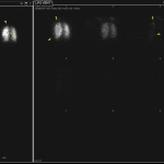 Yellow arrows identify regions of matched defects, which correspond to areas considered abnormal on the CXR, considered a triple match.