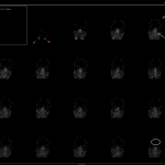 Flow imaging shows arrival of radiotracer in the major arteries of the neck (red arrows), the hot nose sign (yellow arrow), and normal scalp perfusion (green arrow). No intracranial activity is seen (blue circle).