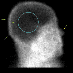 Lateral static view shows similar findings to angiographic phase imaging with absent intracranial activity (blue circle) despite maintained face (yellow arrow) and scalp perfusion (green arrows).