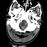 Head CT in this trauma patient showing hemorrhage surrounding the brain stem at the level of the foramen magnum (red arrows). An occipital skull fracture is also seen (purple arrows).