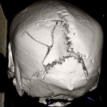 3D CT rendering in this patient shows a comminuted skull fracture extending into the foramen magnum.