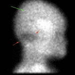 Persistent perfusion to the cerebral cortices (green arrow) with decreased perfusion to the cerebellum (red arrows).