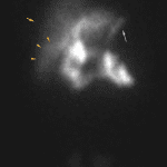 Imaging at 56 minutes shows bowel activity to have moved into the proximal small bowel (brown arrows) and a rim sign (orange arrows) has become more apparent as radiotracer clears from the hepatic parenchyma. There is also reflux of bile into the stomach (pink arrow).