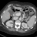 CT in the same patient completed 24 hours before the HIDA, showing several small stones layering in the gallbladder (orange arrow).