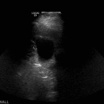 Prior ultrasound in the same patient showing borderline gallbladder wall thickening.