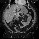 CT from same patient showing a stone in the cystic duct (orange arrow). Duodenum (brown arrows).