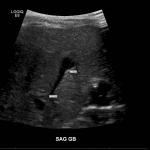 Follow up abdominal ultrasound in the same patient done 2 days later demonstrates a contracted gallbladder, excluding the diagnosis of biliary atresia.