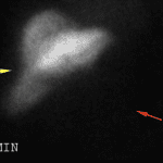 Early imaging shows uptake of radiotracer by the liver (yellow arrow) and clearance from the blood pool (red arrow).