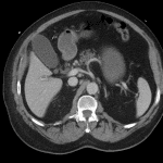 CT in the same patient completed 24 hours before the HIDA demonstrating normal biliary anatomy: gallbladder (light green arrow), cystic duct (dark green arrow), common bile duct (orange arrow).