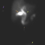 Injection site in the right arm (purple arrow). Normal activity in the gallbladder (orange arrow), common bile duct (green arrow), bowel (brown arrow), and bladder (yellow arrow).