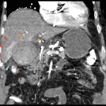 CT in same patient performed 24 hours before the HIDA which showed gallbladder distension (orange arrows), gallstones/sludge, hyperenhancement of the adjacent liver parenchyma (red arrows), and pericholecystic fluid (blue arrow).