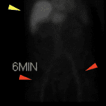 Imaging at 6 minutes demonstrates hepatic uptake (yellow arrow), but persistent blood pool activity (red arrows), which is abnormal if persistent beyond 5 minutes after injection.