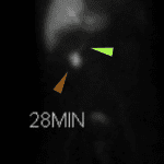 Expected radiotracer activity in the common bile duct (green arrow) and duodenum (brown arrow) before 30 minutes.