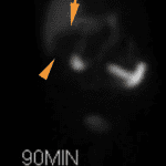 Non-filling of the gallbladder at 90 minutes (orange arrows), even after IV morphine administration.