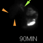 No filling of the gallbladder by 90 minutes (orange arrows point to the gallbladder fossa) even after administration of IV morphine. Normal biliary tree activity (green arrow).
