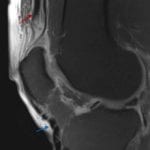 Subsequent MRI shows the torn, retracted quadricpes tendon (red arrow), the buckling of the patellar tendon (blue arrow), and the surrounding edema (signal hyperintensity).