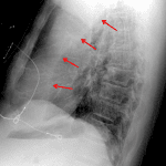 Left upper lobe collapse. Anterior displacement of the left major fissure on the lateral projection (red arrows).