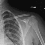 This is the NORMAL left side for comparison