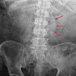 Red arrows: infrarenal abdominal aortic aneurysm.