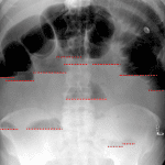 Small bowel obstruction. Red dotted lines highlight many air-fluid levels at different levels in the abdomen on upright imaging.