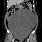 Followup CT in this patient confirms a large, predominantly cystic abdominal mass.