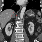 Red arrows: traumatic right adrenal hematoma.