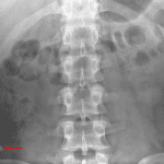 Calcific density overlying the right lower quadrant concerning for an appendicolith (red arrow).