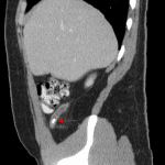 Appendicolith (red arrow) with acute appendicitis confirmed on the subsequent CT, as shown in this representative sagittal reformatted image.