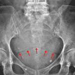 Ascites layering dependently over the bladder dome, separated by a thin rim of fat (red arrows), giving the dog ear appearance.