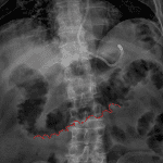 Colitis: mural thickening of the transverse colon resulting in a thumbprinting appearance (some thickening folds are outlined in red).