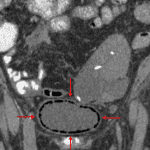 Emphysematous cystitis confirmed on the subsequent CT.