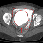 Companion case of extraperitoneal bladder rupture showing the molar tooth sign (red outline) of contrast encircling the bladder on three sides, but conspicuously absent along the posterior margin (red arrow) in the inferior extent of the peritoneal space.