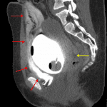 Companion case of extraperitoneal bladder rupture showing extensive contrast leakage in the prevesical space (red arrows), but no contrast in the peritoneal cavity, including in the rectouterine space aka Pouch of Douglas (yellow arrow).