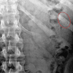 Weakly radiopaque ingested foreign body in the left hemiabdomen (outlined in red).