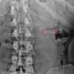 Weakly radiopaque ingested foreign body in the left hemiabdomen (outlined in red).