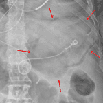 Red arrows: gastric pneumatosis.