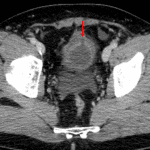 Irregular thickening of the bladder dome with a small defect in the anterosuperior wall (red arrow) concerning for intraperitoneal bladder rupture.