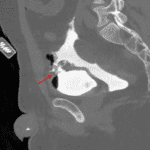 Subsequent CT cystogram confirmed intraperitoneal bladder rupture with site of leak in the anterosuperior bladder wall (red arrow).