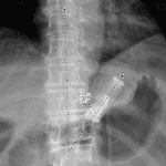 Appropriately positioned lap band which has a rectangular shape and phi angle of 37 degrees.