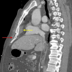 Xiphoid process fracture (red arrow) and subjacent mediastinal hematoma (yellow arrow).