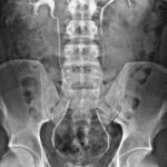 Normal intravenous pyelogram showing the expected course of the ureters for reference.