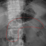 Pancreatic calcifications: array of faint calcifications in the upper abdomen taking the expected shape of the pancreas (outlined in red).