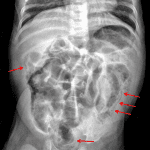Red arrows: linear lucencies along bowel walls in multiple locations, concerning for pneumatosis.