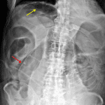 Some findings of pneumoperitoneum on this image include Rigler's sign (red arrow) and lucency beneath the right hemidiaphragm (yellow arrow).