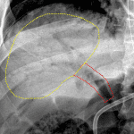 Tree-like configuration of portal venous gas with gas in the main and right portal veins forming the trunk (red outline) and more fine linear branching gas extending toward the periphery of the liver (yellow outline).