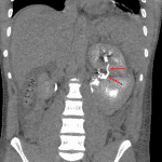 Red arrows: urine leak from the left renal collecting system confirmed on subsequent CT urogram.