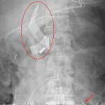 Retained surgical sponge (red outline) and needle (red arrow).