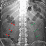 Loss of the right psoas outline (red arrows) compared to the preserved outline on the left (green arrows) in this patient with a retroperitoneal hematoma.