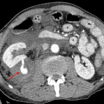 Retroperitoneal hematoma confirmed on the subsequent CT with active hemorrhage from the right kidney (red arrow).